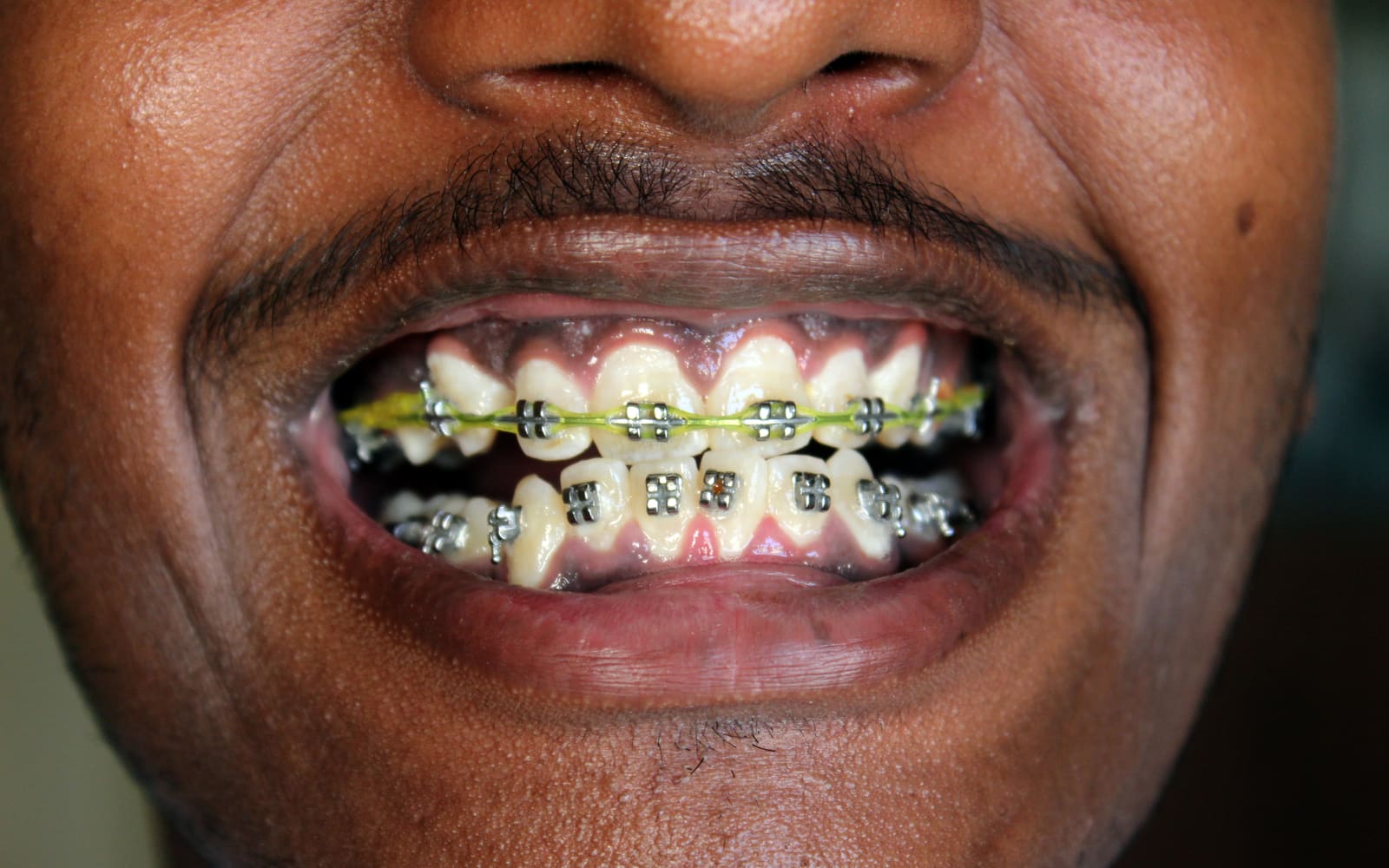 Retainers After Braces or Aligners: Why They Matter in Gurgaon